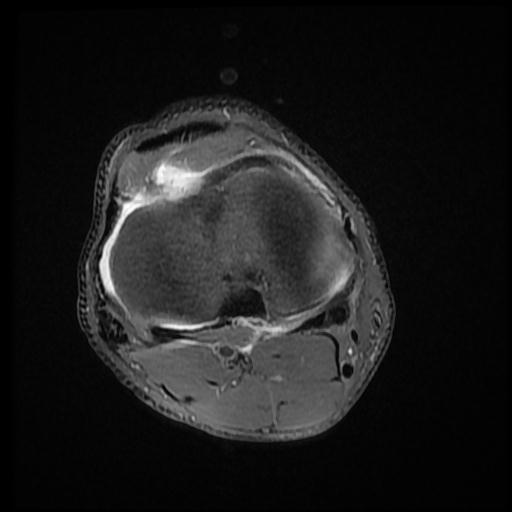 File:Bucket handle tear - medial meniscus (Radiopaedia 69245-79026 Axial PD fat sat 14).jpg