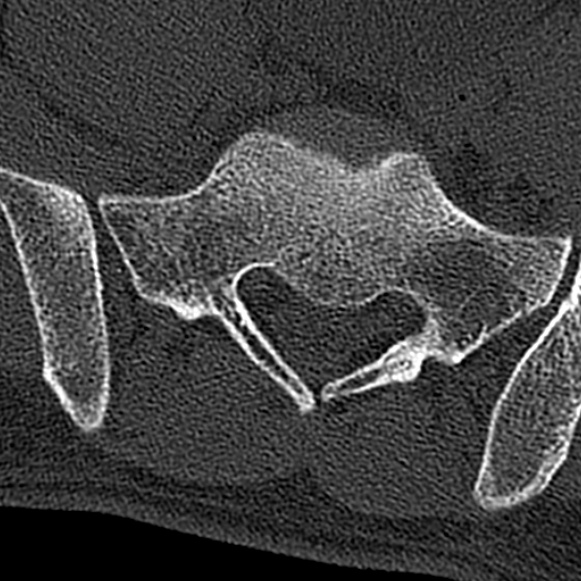 Burst fracture (Radiopaedia 53373-59357 Axial bone window 70).jpg