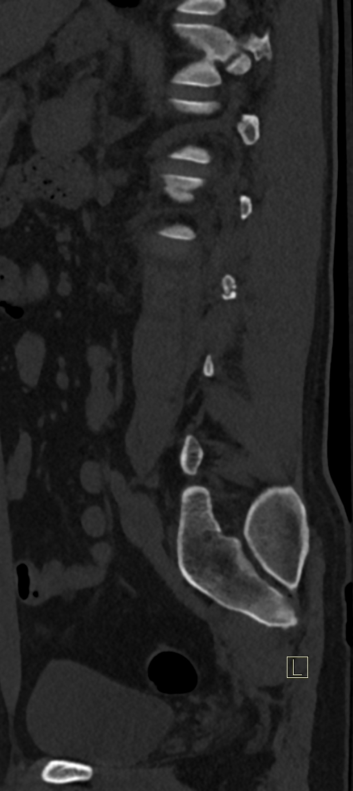 Calcaneal fractures with associated L2 burst fracture (Radiopaedia 71671-82493 Sagittal bone window 16).jpg