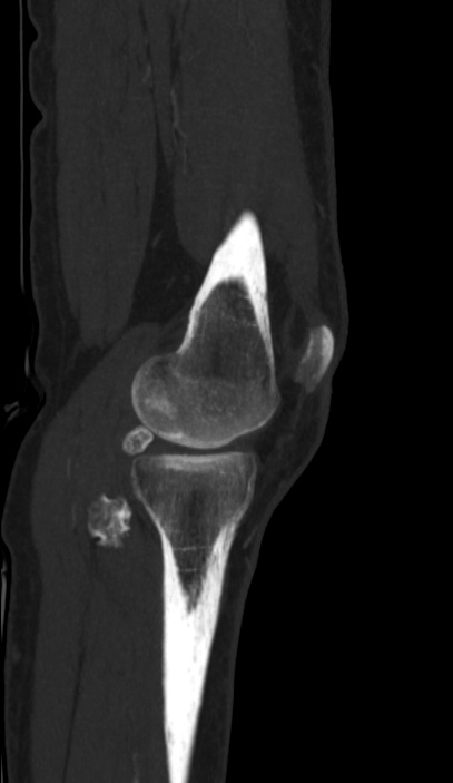 Calcified hematoma - popliteal fossa (Radiopaedia 63938-72763 D 6).jpg