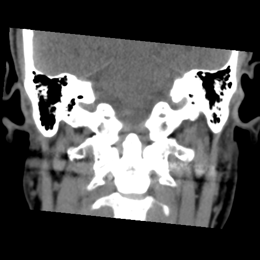 Calcifying pseudoneoplasm of neuraxis (Radiopaedia 44076-47617 Coronal non-contrast 26).png