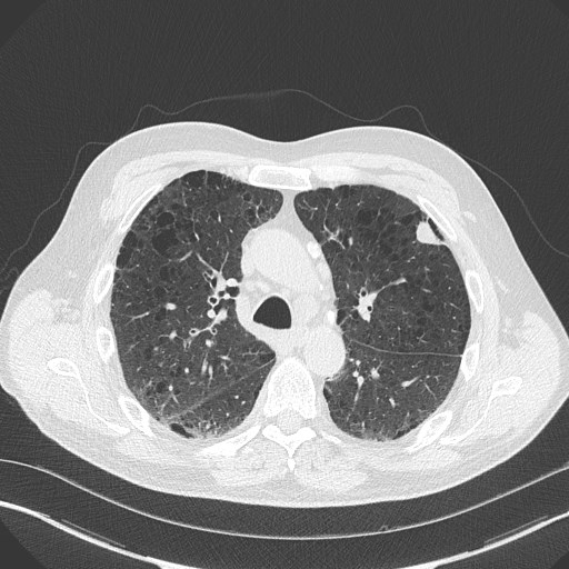 Caplan syndrome (Radiopaedia 56667-63530 Axial lung window 76).jpg