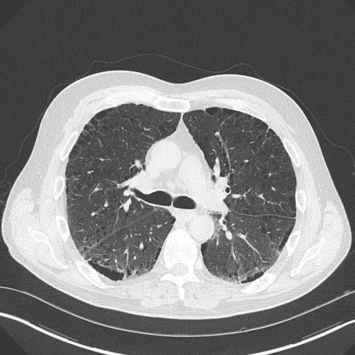 Caplan syndrome (Radiopaedia 56667-63530 Axial lung window 89).jpg