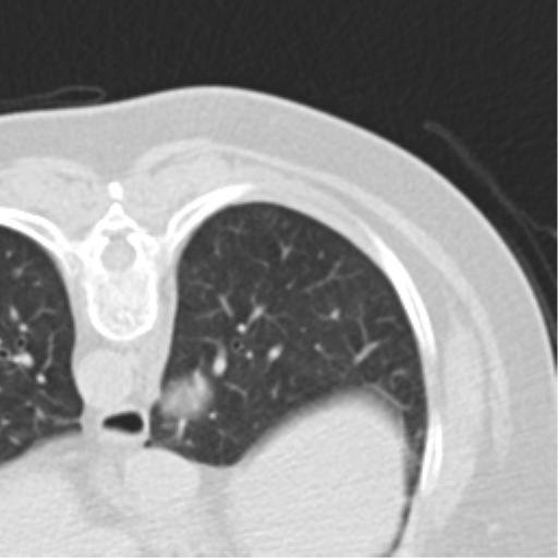 File:Carcinoid tumor - lung (Radiopaedia 44814-48644 Axial lung window 10).png