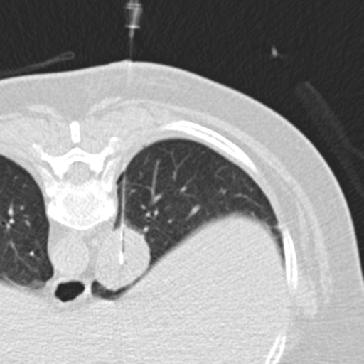 File:Carcinoid tumor - lung (Radiopaedia 44814-48644 Axial lung window 86).png