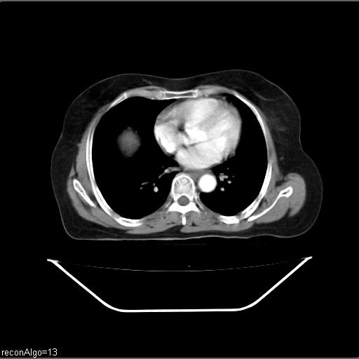 Carcinoma cervix- recurrence (Radiopaedia 34702-36137 B 2).jpg