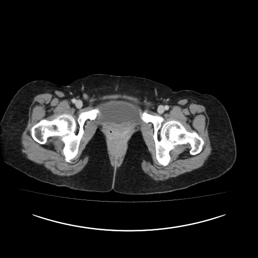 File:Carcinoma colon - hepatic flexure (Radiopaedia 19461-19493 A 128).jpg