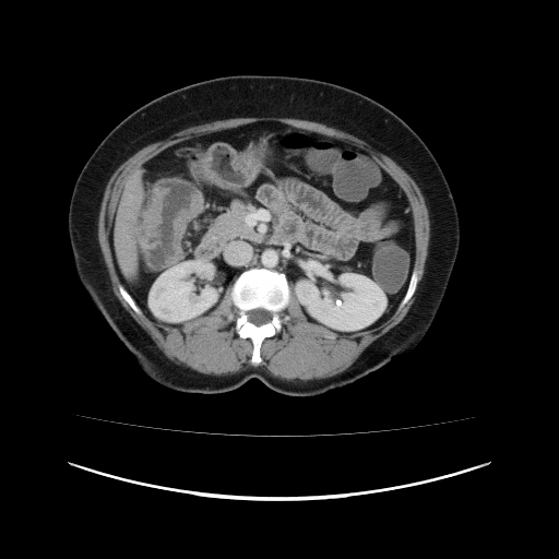File:Carcinoma colon - hepatic flexure (Radiopaedia 19461-19493 A 51).jpg