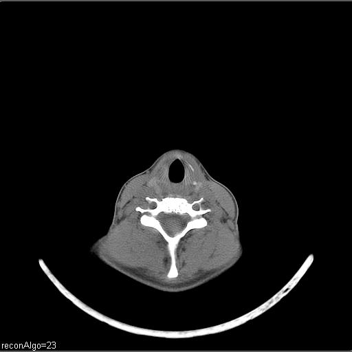 File:Carcinoma of the maxillary antrum (Radiopaedia 53805-59888 Axial non-contrast 22).jpg