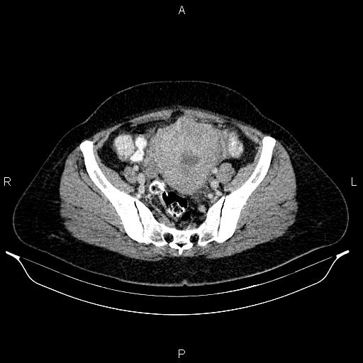Carcinoma of uterine cervix (Radiopaedia 85861-101700 A 65).jpg