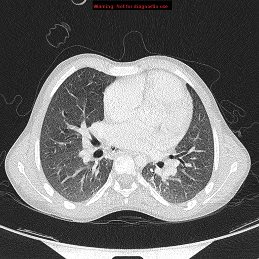 File:Cardiac bronchus (Radiopaedia 14059-13899 A 26).jpg