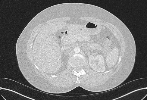 File:Cardiac sarcoidosis (Radiopaedia 74548-85534 Axial lung window 100).jpg