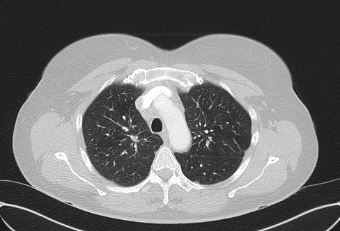 Cardiac sarcoidosis (Radiopaedia 74548-85534 Axial lung window 22).jpg