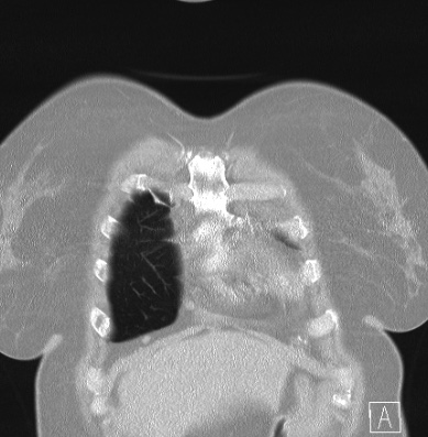 Cardiac sarcoidosis (Radiopaedia 74548-85534 Coronal lung window 5).jpg