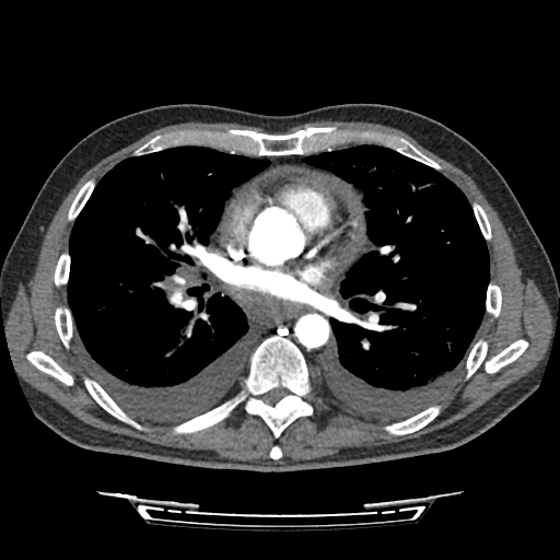 Cardiac tamponade (Radiopaedia 78607-91368 Axial C+ CTPA 46).jpg