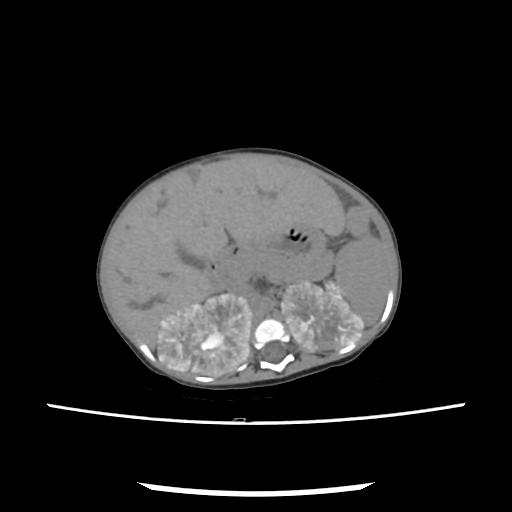 File:Caroli disease with autosomal recessive polycystic kidney disease (ARPKD) (Radiopaedia 89651-106703 E 82).jpg