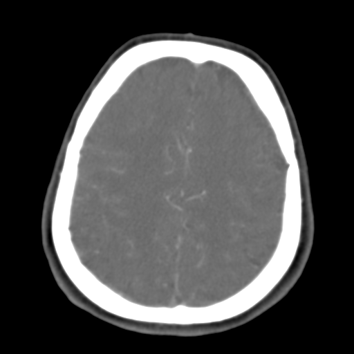 Carotico ophthalmic aneurysm (Radiopaedia 42916-46148 A 15).png
