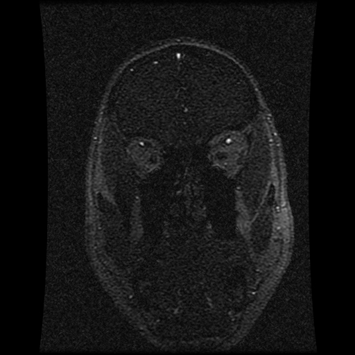 Carotid arterial dissection with acute cerebral infarction (Radiopaedia 26636-26784 MRV 129).jpg