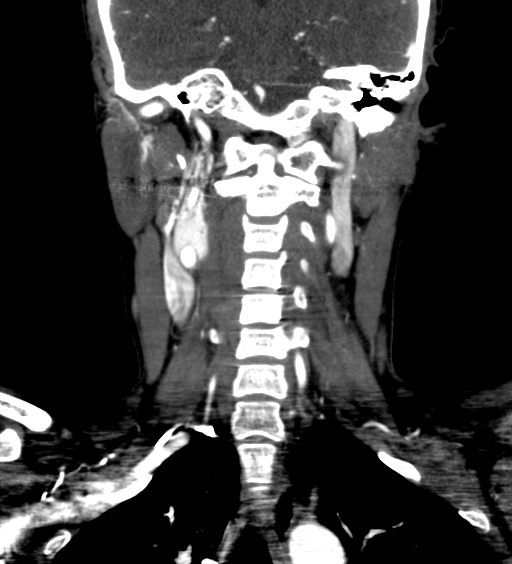 Carotid body tumor (Radiopaedia 39845-42300 C 54).jpg