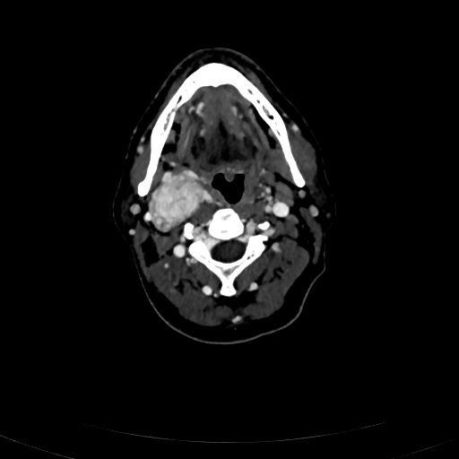 Carotid body tumor (Radiopaedia 83615-98727 D 51).jpg