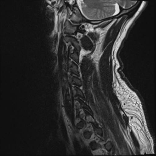 File:Cavernoma of cervical cord (Radiopaedia 50838-56347 C 2).png