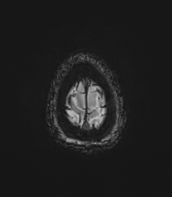 File:Cavernoma with bleed - midbrain (Radiopaedia 54546-60773 Axial SWI 46).png