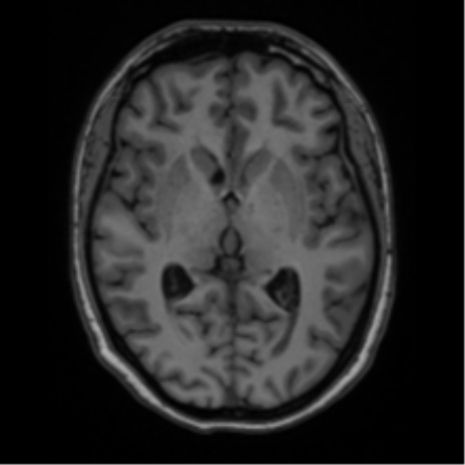 Cavernoma with bleed - midbrain (Radiopaedia 54546-60774 Axial T1 21).png