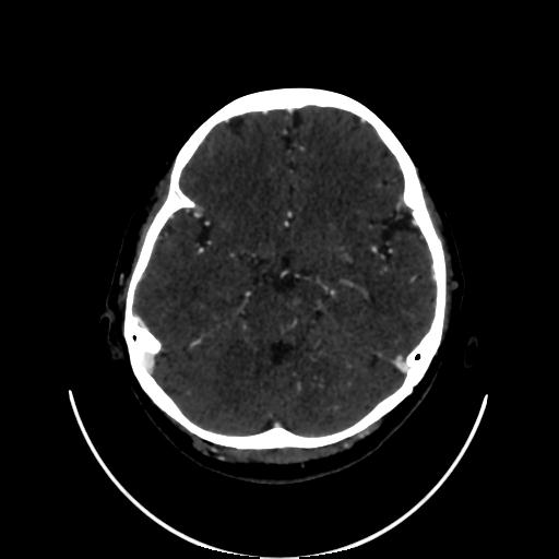 Cavernoma with developmental venous anomaly (Radiopaedia 22470-22506 C 55).jpg