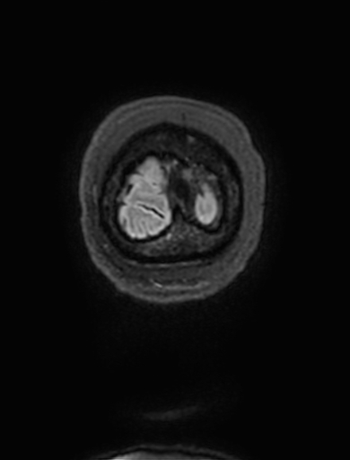 Cavernous hemangioma of the cerebellar falx (Radiopaedia 73025-83724 Coronal FLAIR 351).jpg