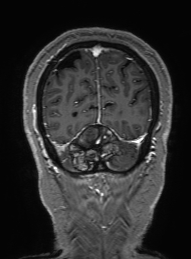 Cavernous hemangioma of the cerebellar falx (Radiopaedia 73025-83724 Coronal T1 C+ 324).jpg