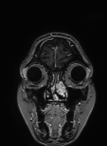 Cavernous hemangioma of the cerebellar falx (Radiopaedia 73025-83724 Coronal T1 C+ 39).jpg