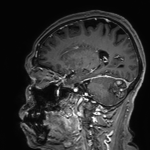 Cavernous hemangioma of the cerebellar falx (Radiopaedia 73025-83724 Sagittal T1 C+ 136).jpg