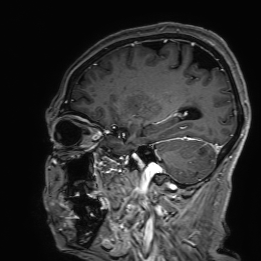 Cavernous hemangioma of the cerebellar falx (Radiopaedia 73025-83724 Sagittal T1 C+ 149).jpg