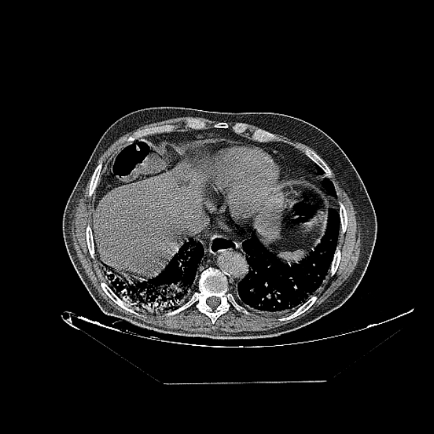 Cavitating bronchogenic carcinoma (Radiopaedia 44489-48162 Axial non-contrast 67).jpg