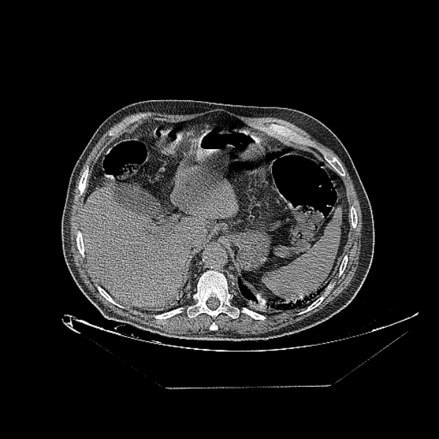 Cavitating bronchogenic carcinoma (Radiopaedia 44489-48162 Axial non-contrast 83).jpg