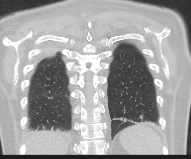 Cavitating pneumonia (Radiopaedia 45998-50329 Coronal lung window 40).png