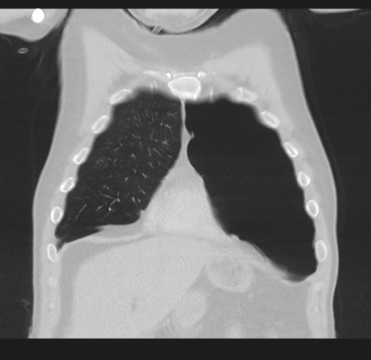 Cavitating pneumonia complicated by pneumothorax (Radiopaedia 48149-52994 Coronal lung window 14).png