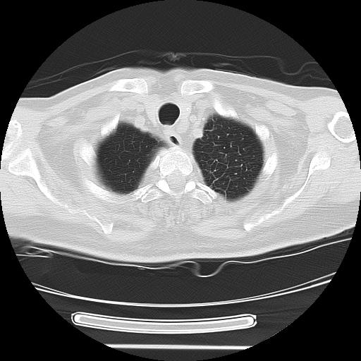 Cavitating pulmonary metastases (Radiopaedia 89545-106544 Axial lung window 6).jpg