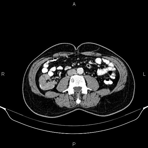 File:Cecal adenocarcinoma (Radiopaedia 85324-100916 B 54).jpg