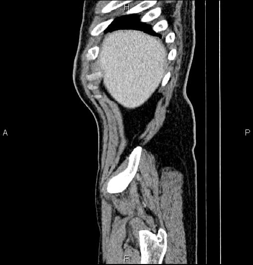 Cecal adenocarcinoma (Radiopaedia 85324-100916 E 8).jpg