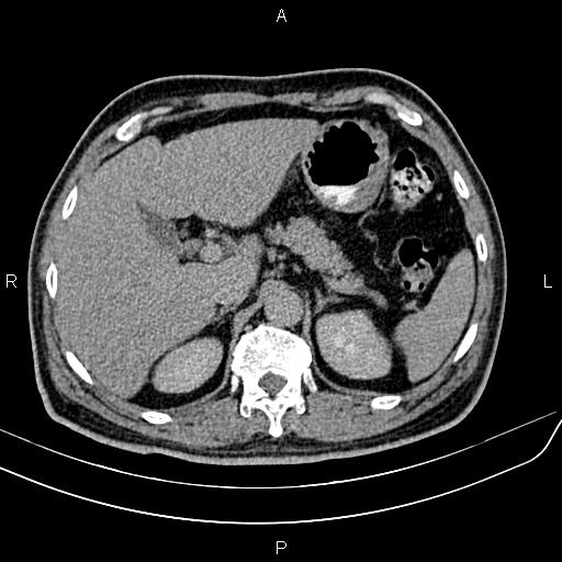 File:Cecal cancer with appendiceal mucocele (Radiopaedia 91080-108651 Axial C+ delayed 8).jpg