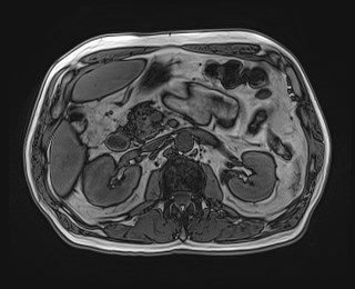 Cecal mass causing appendicitis (Radiopaedia 59207-66532 D 54).jpg