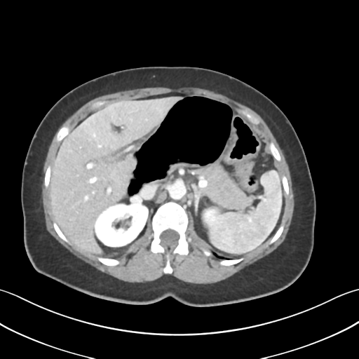 Cecum hernia through the foramen of Winslow (Radiopaedia 46634-51112 A 21).png