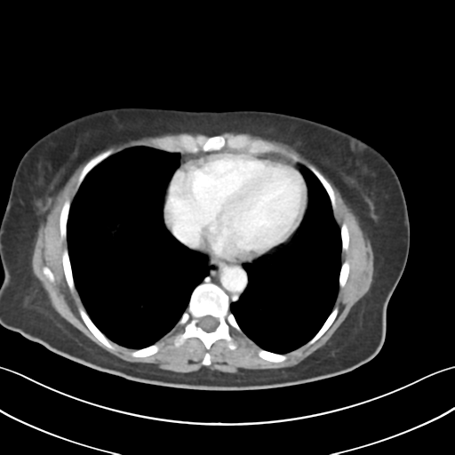 Cecum hernia through the foramen of Winslow (Radiopaedia 46634-51112 A 3).png