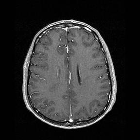 Central-variant posterior reversible encephalopathy syndrome (PRES) (Radiopaedia 43880-47358 Axial T1 C+ 111).jpg