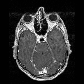 File:Central-variant posterior reversible encephalopathy syndrome (PRES) (Radiopaedia 43880-47358 Axial T1 C+ 47).jpg