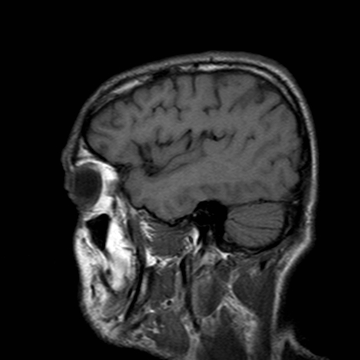 File:Central-variant posterior reversible encephalopathy syndrome (PRES) (Radiopaedia 43880-47359 Sagittal T1 4).jpg