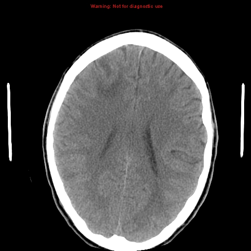File:Central nervous system vasculitis (Radiopaedia 8410-9234 Axial non-contrast 17).jpg