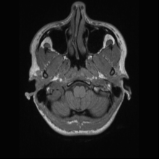 File:Central neurocytoma (Radiopaedia 37664-39557 Axial T1 8).png