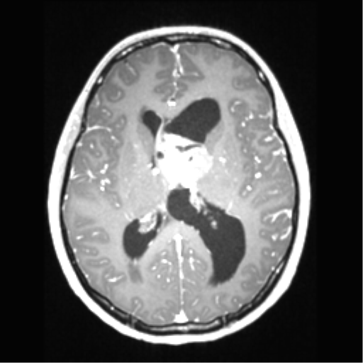 Central neurocytoma (Radiopaedia 37664-39557 Axial T1 C+ 44).png